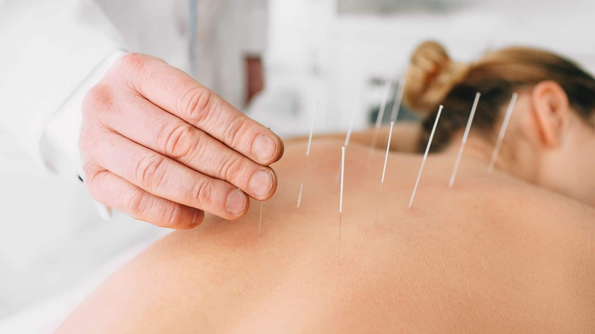 acupuntura